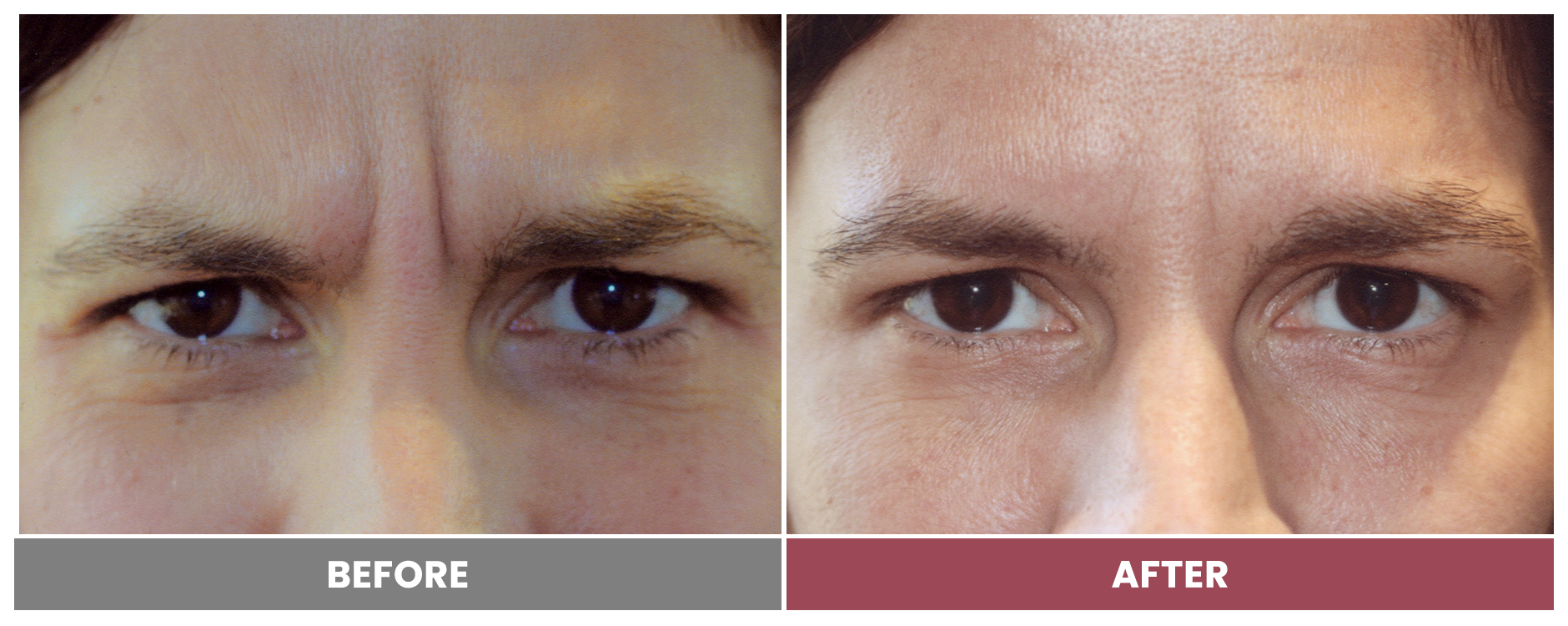 BOTOX FOR WRINKLES & BROW LIFT - Case 13